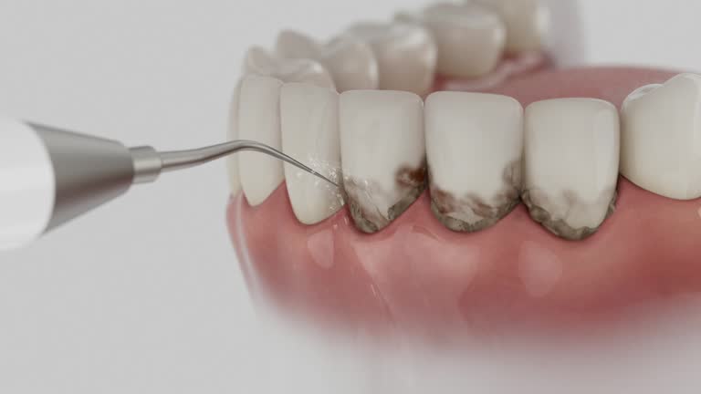Trusted Wisdom Tooth Removal service in West Lealman, FL - Dentist Open Now